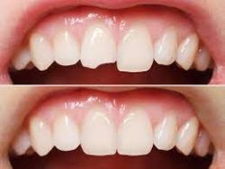Dental Veneers for Cracked Teeth |Fix a Chipped Tooth With a Dental Veneer