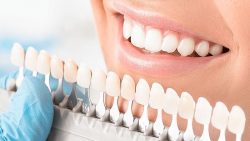 Consultation Appointment for Dental Veneers