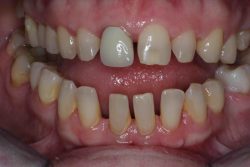 porcelain veneers before and after |Dental Ceramic or Porcelain Veneers Before And After