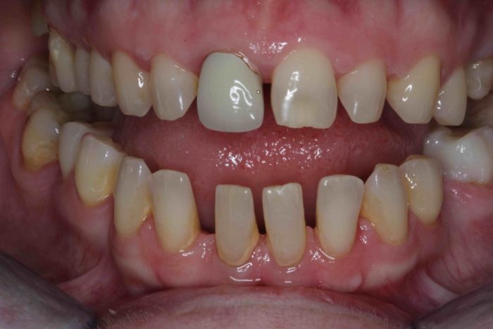 porcelain veneers before and after |Dental Ceramic or Porcelain Veneers Before And After