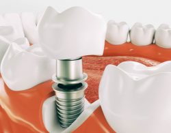 Implant Dentist Surfside, FL | Implant Dentistry Near Me