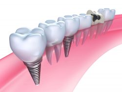 Affordable Dental Implants Clinic |Painless Dental Implants
