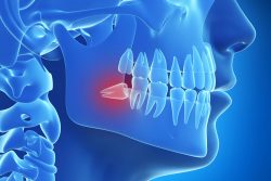 Wisdom Teeth Removal: Procedure & Recovery