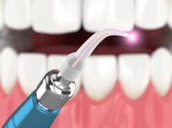 Houston Laser Dentistry | Sugar Land Cosmetic Dentist