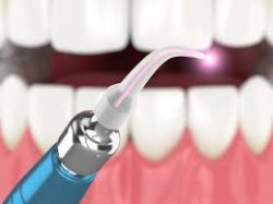 LANAP Laser Dentistry In Houston TX |Houston LANAP Procedure