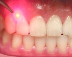 Laser Dentistry Houston, TX | Gentle Laser Dentist Near Me