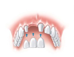 Dental Implants Doctors| Dentist That Do Implants Near Me