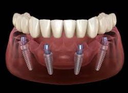 Dental Implants: A Painless Option To Bring Back Your Smile