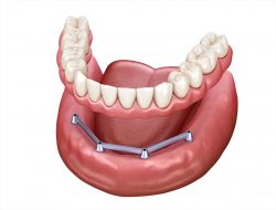 Dentures and Implants: What Are Dental Implants for Dentures?