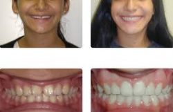 Adult Braces Before And After: Which Orthodontics Are For You?