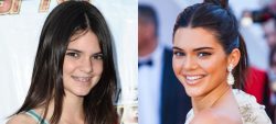 Adult Braces Before And After: Adult braces before and after