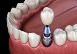 Affordable Dental Veneers Near Me | Dental Veneers Cost Houston | Affordable Porcelain Veneers