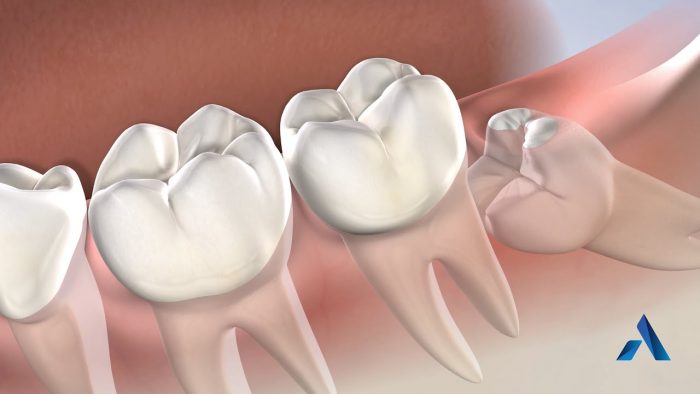 Wisdom Teeth Removal Houston TX | Wisdom Teeth Extraction Near Me| Wisdom Teeth Extraction in Ho ...