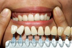 Benefits of Dental Bonding – What Are The Benefits Of Teeth Cosmetic Bonding?