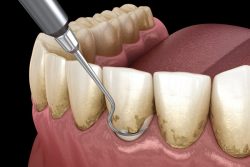 The Benefits of Deep Cleaning Teeth-What Are The Advantages Of Deep Cleaning Teeth?