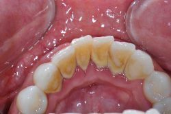 Advantages of Deep Cleaning Teeth-What Are The Advantages Of Deep Cleaning Teeth?