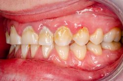 Benefits of Deep Cleaning Teeth-What Are The Advantages Of Deep Cleaning Teeth?