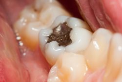 Advantages of Dental Fillings-What Are The Benefits Of Getting A Dental Filling?