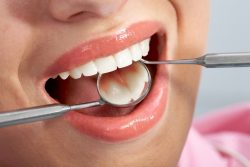 Benefits of Fillings-What Are The Benefits Of Getting A Dental Filling?