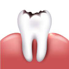 Composite Tooth Fillings in Houston TX
