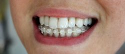 Understanding Six Month Smiles Braces – Six Month Smiles Before And After