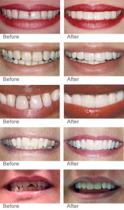 Vaneers Before and After | Porcelain Veneers Before & After Photos