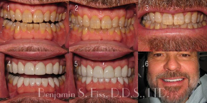 porcelain veneers before and after Porcelain Veneers Before & After Photos