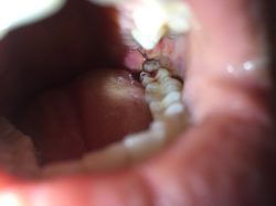 What is the Recovery Time after Wisdom Teeth Removal