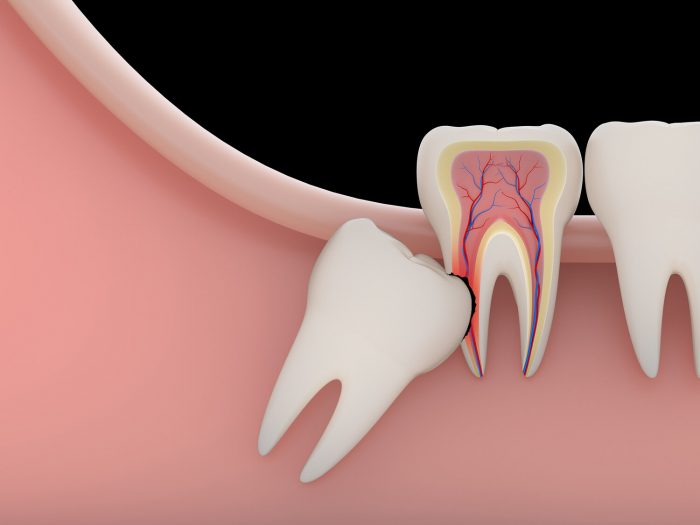 Wisdom Tooth Extraction Recovery Time | Wisdom Teeth Removal