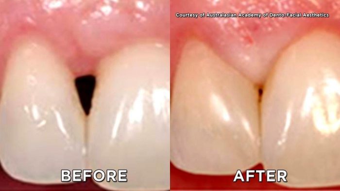 Gum Regenerative Procedures | Periodontist in Chicago