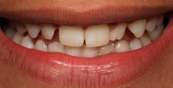 What is composite bonding teeth?