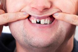 Fix Cavity on Front Tooth | Symptoms And Causes