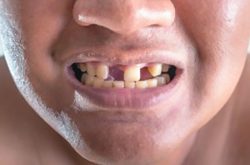 Fix Cavity on Front Tooth | Cavities on Front Teeth