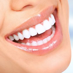 Laser Teeth Whitening – Houston – Galleria Dental Center