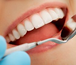 Professional Teeth Whitening Near Me – Houston – URBN Dental
