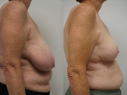 Breast Reduction Surgery: Procedure, Recovery, Cost,