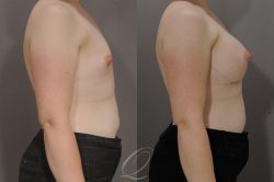 Breast Enhancement Before & After Pictures