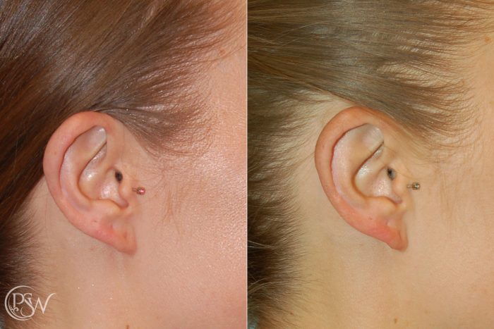 Otoplasty Ear Reshaping Houston Sugar Land Galveston TX