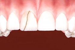 Veneers to Cover Chips and Cracks – McCarthy Dentistry
