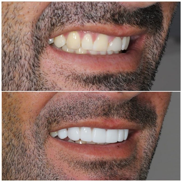 Vaneers Before and After | Veneers Before and After – Brunswick East Dental Studio