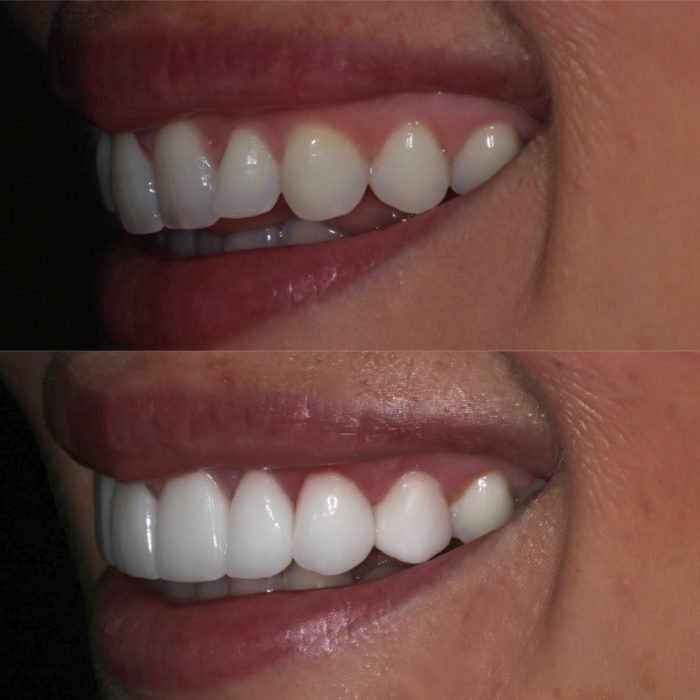 porcelain veneers before and after | Veneers Before and After – Brunswick East Dental Studio