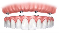 All On 4 Dental Implants in Aventura | Dental Implants Aventura, FL – Diana Wohlstein, DMD