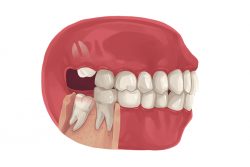Wisdom Tooth Removal Recovery Time | Tips for FAST Recovery After Wisdom Teeth Removal