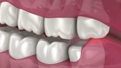 Wisdom Tooth Removal Recovery Time | Wisdom tooth removal