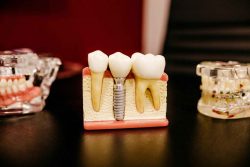 Finding The Best Dental Implants Near Me