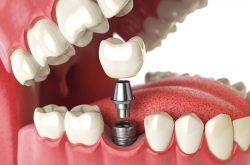 Finding The Best Dental Implants Near Me |Best dentist for tooth implant