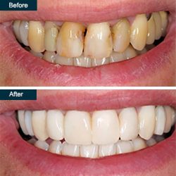 What Exactly Is Deep Cleaning? | What Is Involved in the Process of Deep Cleaning of Teeth?