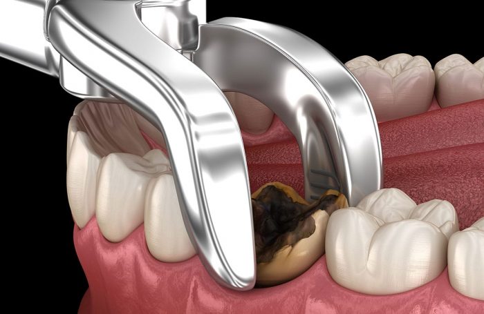 How Long is Wisdom Teeth Recovery Time?