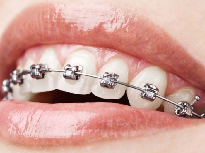 Best Braces Dentist Near Me