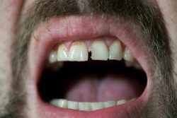 Dental Veneers for Cracked Teeth | Veneers to Cover Chips and Cracks – McCarthy Dentistry